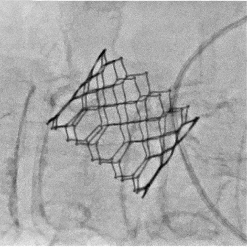 Structural heart disease