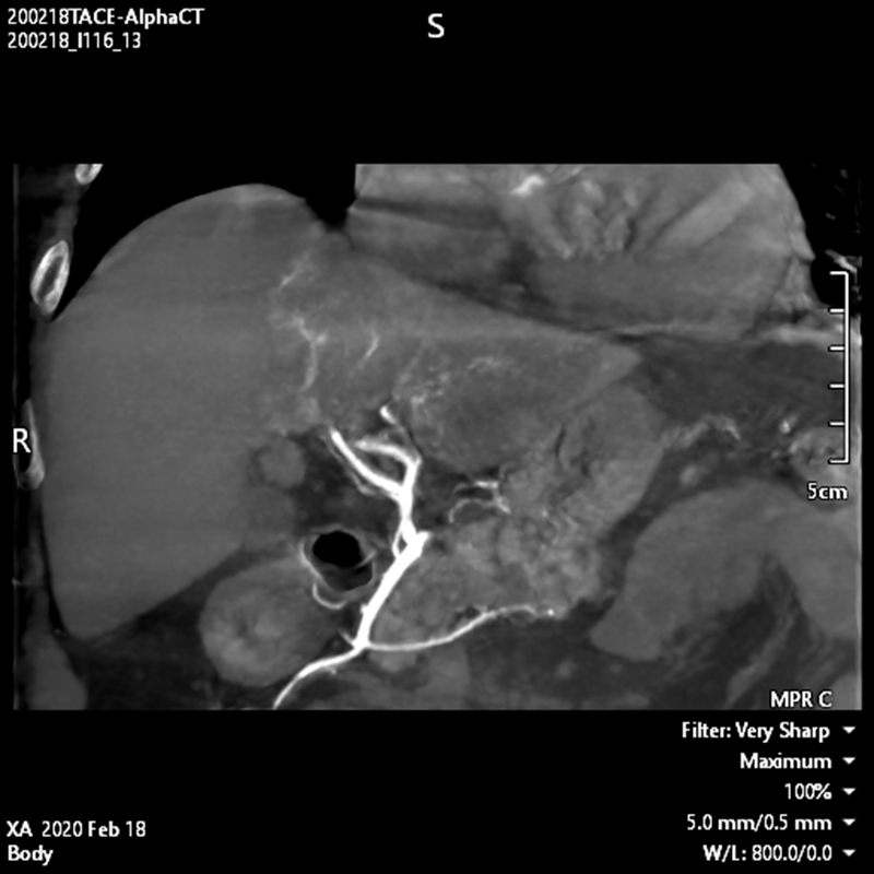 Alphenix Abdominal Alpha CT