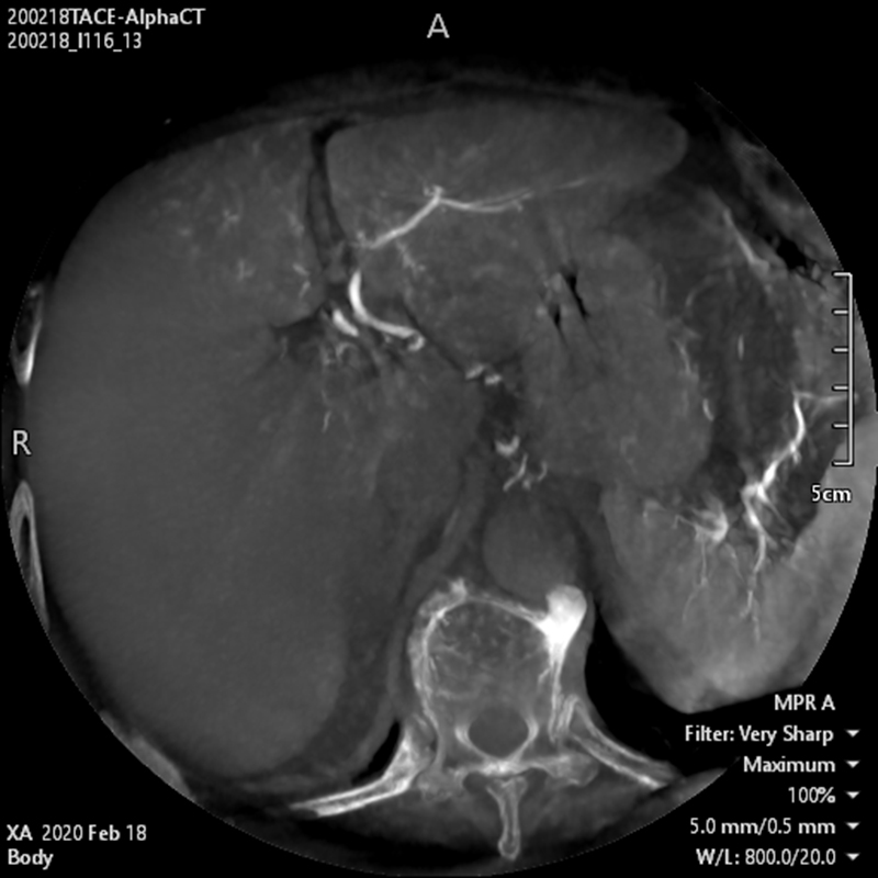 Alphenix Abdominal Alpha CT