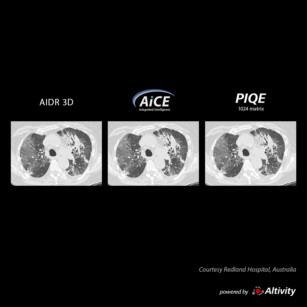 Precise IQ Engine Venous Phase Chest