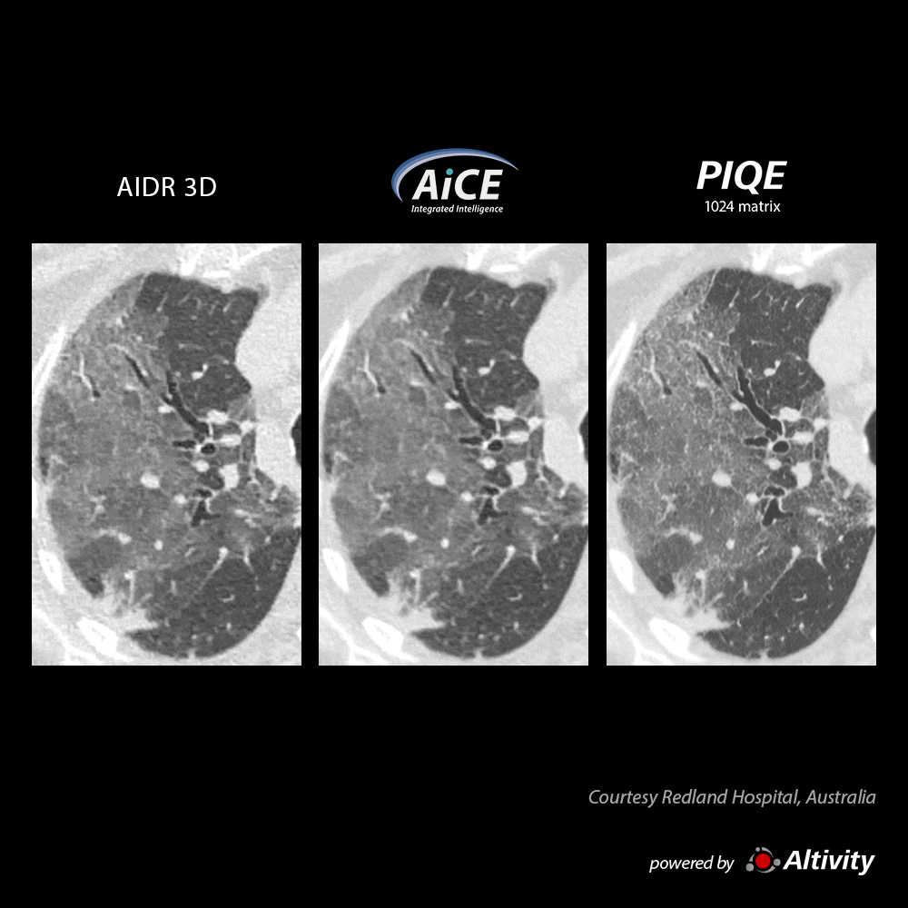 Precise IQ Engine Venous Phase Chest